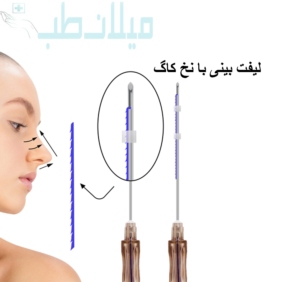 نخ لیفت بینی برند مدیلیفت مدل کاگ سایز G19.50mm